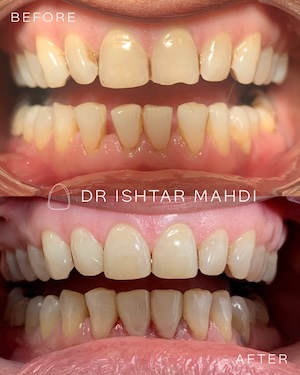 Composite bonding