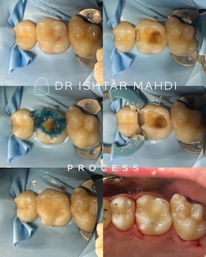 Gingival veneers
