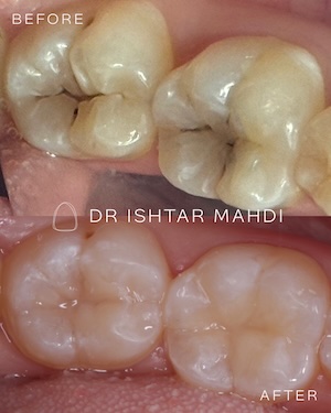 Gingival veneers