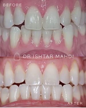 Gingival veneers